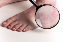 A inibição de uma via metabólica lipídica específica foi associada à redução do risco de psoríase A inibição de uma via metabólica lipídica específica foi associada à redução do risco de psoríase