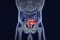 Estudo mostra que quase metade dos casos de c&acirc;ncer colorretal agora ocorre em pacientes mais jovens