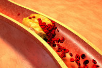 FDA aprova primeiro comprimido inibidor de PCSK9, capaz de reduzir drasticamente o colesterol LDL