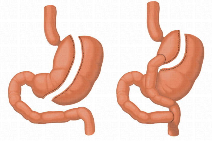 Cirurgia bariátrica traz benefícios cardíacos no longo prazo independente da idade e do estado de diabetes