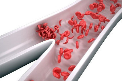 Co&aacute;gulos sangu&iacute;neos dos membros inferiores da terapia contra o c&acirc;ncer s&atilde;o melhor tratados com anticoagula&ccedil;&atilde;o prolongada