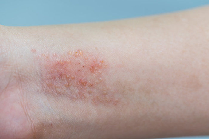 Dermatite at&oacute;pica infantil foi associada a maiores riscos de dificuldades de aprendizagem e mem&oacute;ria