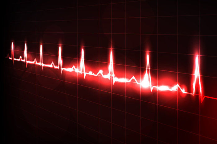 Desenvolvimento de fibrila&ccedil;&atilde;o atrial de in&iacute;cio recente na UTI aumentou o risco de mortalidade intra-hospitalar e hospitaliza&ccedil;&atilde;o subsequente com FA