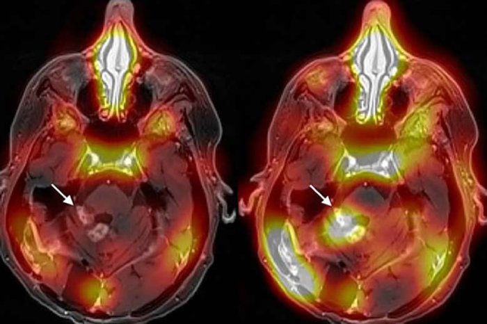 Ensaio clínico inédito demonstra que ultrassom focalizado pode fornecer terapia com anticorpos para metástases de câncer de mama no cérebro