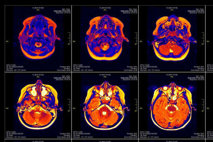 Estudo sobre fumantes cujo vício desapareceu após um AVC aponta para um circuito cerebral que pode alimentar o vício