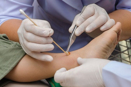 Gel tópico de esmolol ajudou a curar úlceras de pé diabético
