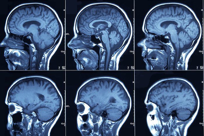 Medicamentos inibidores do SRAA para hipertensão podem proteger contra rupturas de aneurismas cerebrais