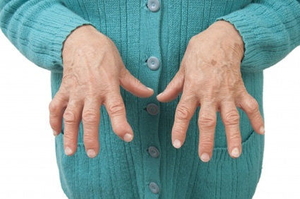 Novo medicamento biol&oacute;gico melhora os sintomas refrat&aacute;rios da artrite reumatoide