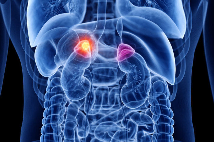 Novo regime de quimioimunoterapia impressiona no neuroblastoma pediátrico