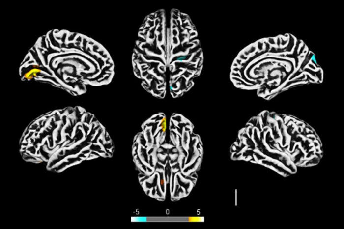 O SARS-CoV-2 infecta astr&oacute;citos cerebrais de pacientes com COVID-19 e prejudica a viabilidade neuronal