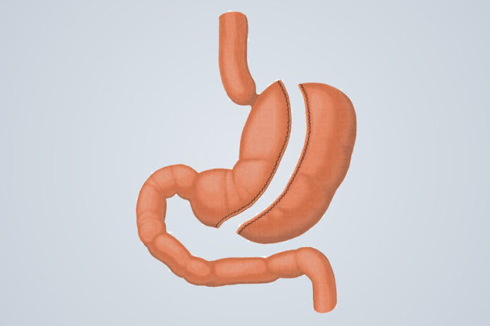 Procedimento bariátrico minimamente invasivo se mostrou eficaz para obesidade leve e moderada