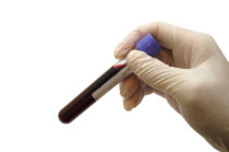 <i>FDA</i> aprova fator anti-hemofílico modificado para a hemofilia A
