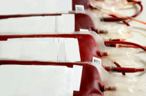 <i>NEJM</i>: uso de transfusões de sangue regulares na prevenção de infartos cerebrais em crianças com anemia falciforme