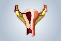 A endometriose poderia ser controlada com injeções mensais de anticorpos