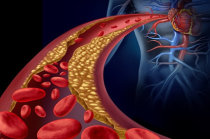 A hipertrigliceridemia aumenta o risco de AVC recorrente, apesar do uso de estatinas e colesterol LDL bem controlado