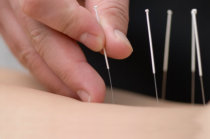 Acupuntura pode reduzir sintomas da fibromialgia, publicado pelo <i>Acupuncture in Medicine</i>