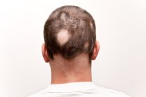 Três pacientes com alopécia areata recuperaram seus cabelos com o medicamento ruxolitinib, publicado pela <i>Nature Medicine</i>