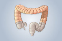 Bact&eacute;rias t&oacute;xicas podem ajudar a desencadear a colite ulcerativa, um tipo comum de doen&ccedil;a inflamat&oacute;ria intestinal