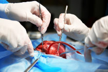 Cirurgia de revascularização do miocárdio, o procedimento cardíaco mais comum no Brasil, não é tão segura para mulheres mais velhas
