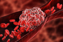 Coágulos sanguíneos dos membros inferiores da terapia contra o câncer são melhor tratados com anticoagulação prolongada