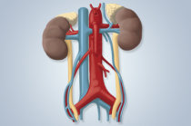 Dapagliflozina diminui o risco de resultados adversos renais e cardiovasculares em pacientes com doença renal crônica