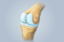 Estudo descreve um hidrogel injetável para regenerar a cartilagem danificada nas articulações