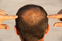 Folículos capilares foram cultivados em laboratório, em um passo para o tratamento da perda de cabelo