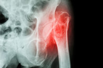Injeções de nanopartículas cheias de medicamentos podem aliviar a dor da artrite
