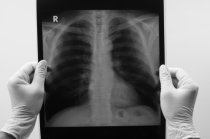 Meta da OMS é acabar com a epidemia global de tuberculose até 2035