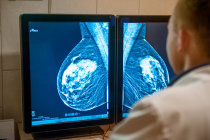 Modelo de risco de câncer de mama baseado em mamografia pode oferecer melhorias no atendimento