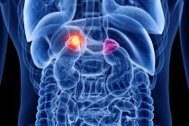 Novo medicamento reduz a necessidade de esteroides na hiperplasia adrenal congênita