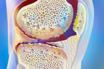 O fator de crescimento neural (NGF) pode desempenhar um papel mais importante na osteoartrite do que se pensava anteriormente
