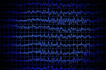 Ondas cerebrais durante o sono preveem o risco de demência Ondas cerebrais durante o sono preveem o risco de demência