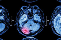 Pílula tripla ajuda sobreviventes de hemorragia intracerebral a atingirem suas metas de pressão arterial Pílula tripla ajuda sobreviventes de hemorragia intracerebral a atingirem suas metas de pressão arterial