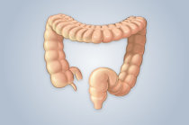 Polipose gastrointestinal pode estar associada à terapia para câncer na infância e em adultos jovens, publicado pelo <i>Cancer Prevention and Research</i>
