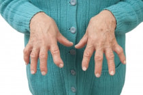 Resultados de um tratamento de 6 semanas com 10 mg de prednisolona em pacientes com osteoartrite da mão