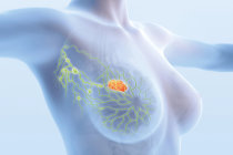 Tipo de câncer de mama difícil de detectar está em ascensão: taxas de carcinoma lobular invasivo aumentaram quase 3% ao ano de 2012 a 2021 Tipo de câncer de mama difícil de detectar está em ascensão: taxas de carcinoma lobular invasivo aumentaram quase 3% ao ano de 2012 a 2021