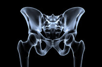 Tratamento da baixa densidade óssea e da osteoporose para prevenção de fraturas: prática clínica do <i>American College of Physicians</i>