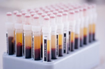 Um simples exame de sangue pode prever risco de doença hepática grave