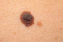 Vacina contra melanoma reduz pela metade o risco de recorrência e metástase em 5 anos Vacina contra melanoma reduz pela metade o risco de recorrência e metástase em 5 anos