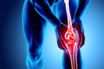 Órtese para joelho pode ajudar os ligamentos cruzados anteriores rompidos a se curarem sozinhos