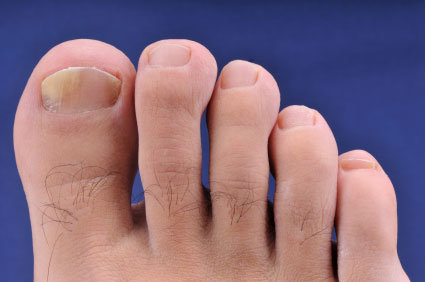 Apoio aos pacientes: Micoses superficiais - Como evit&aacute;-las?