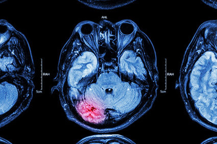 Medicamentos inibidores do SRAA para hipertensão podem proteger contra rupturas de aneurismas cerebrais