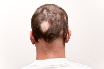 Um inibidor de JAK oral, Baricitinibe, produziu crescimento capilar dramático e durável em pacientes com alopecia areata grave