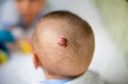Pediatrics: propranolol diminui volume, coloração e elevação de hemangiomas infantis