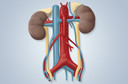 A hipertensão arterial pode ser tratada pela denervação renal, queimando os nervos próximos aos rins
