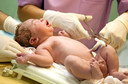 A ordenha do cordão umbilical pode ser segura e mais eficaz para recém-nascidos não vigorosos nascidos a termo ou no pré-termo tardio