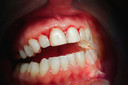 Associação entre periodontite e fibrilação atrial foi aprofundada por achados histológicos