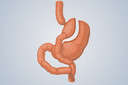 Cirurgia de bypass gástrico pode reduzir o risco de câncer de intestino