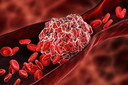 Coágulos sanguíneos dos membros inferiores da terapia contra o câncer são melhor tratados com anticoagulação prolongada